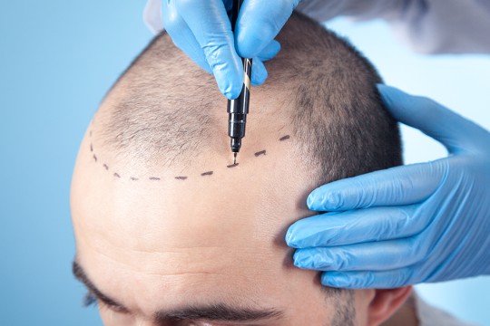 Hair Transplant Treatment of Hair Derma Image
