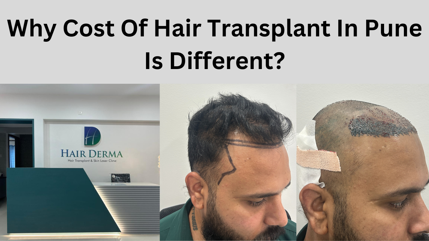 Hair Transplant Cost in Pune