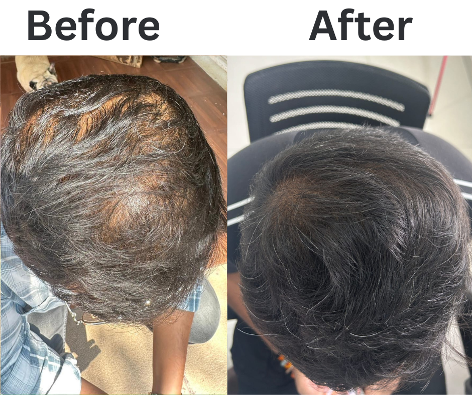 PRP treatment before after images of Hair Derma Clinic patient