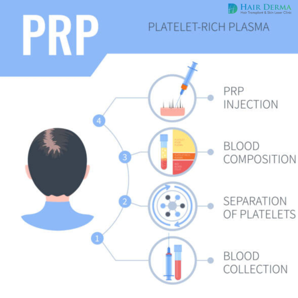 PRP Therapy Steps Image Of Hair Derma Clinic